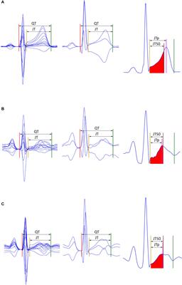 Detection of T Wave Peak for Serial Comparisons of JTp Interval